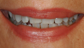 Dental Veneers Midline Diastema Present in Upper Front Teeth