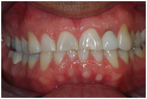 Before full mouth rehabilitation treatment