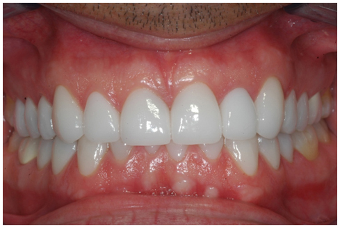 After full mouth rehabilitation treatment