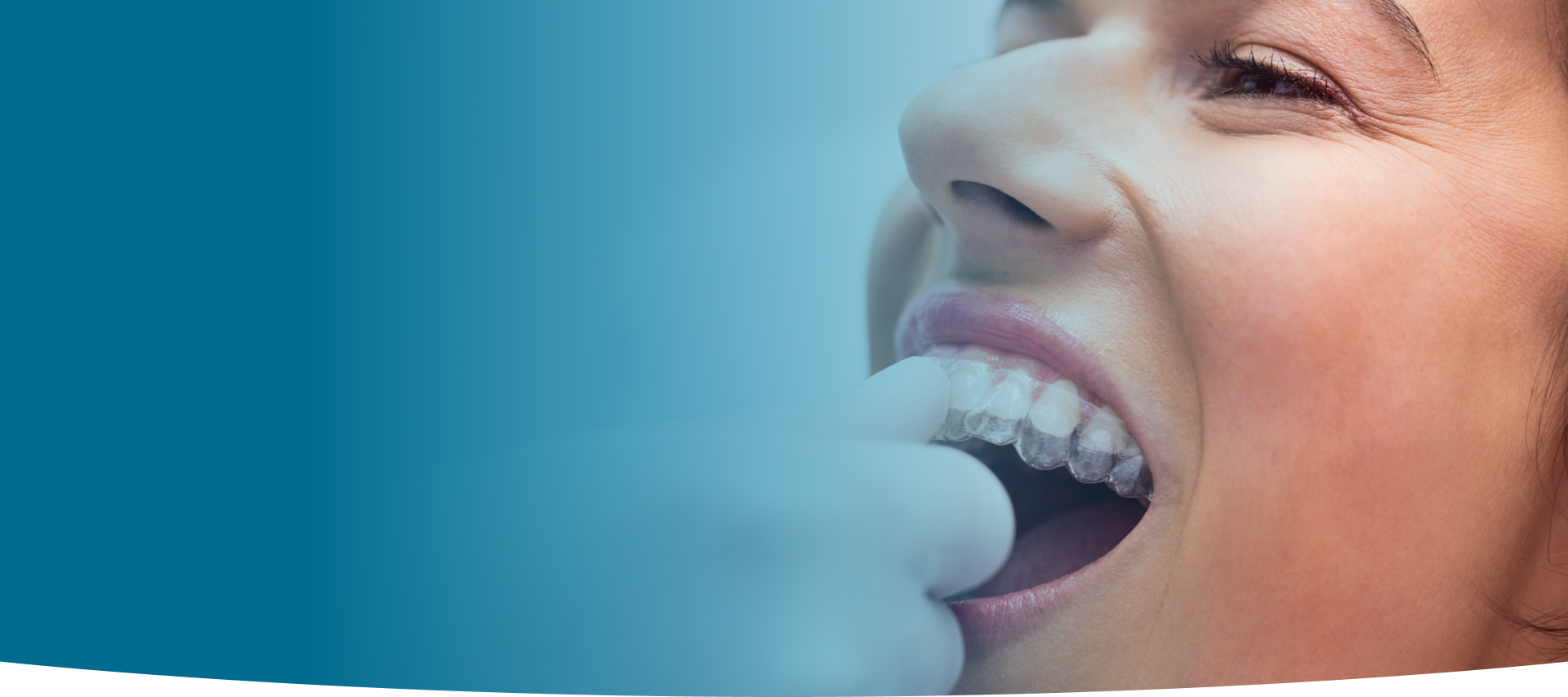 Dental Invisalign at World Dental Specialities