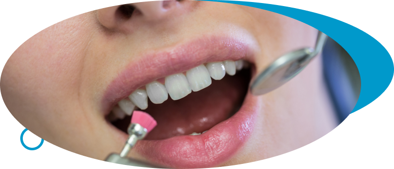 Dental Bonding at World Dental Specialities