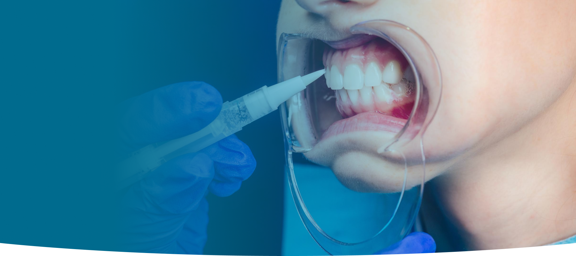 Gummy Smile Treatment at World Dental Specialities
