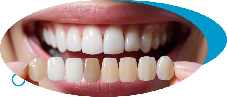Porcelain Laminate Veneers at World Dental Specialities