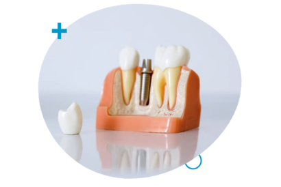 Dental Implants services Mumbai
