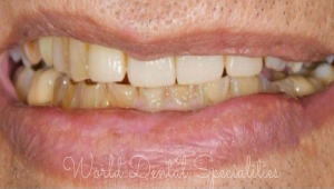 Full Mouth rehabilitation in Mumbai