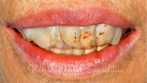Full mouth restoration Mumbai