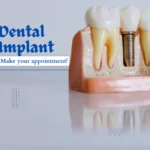 Implant Dentist in Mumbai offering the latest Dental Implants
